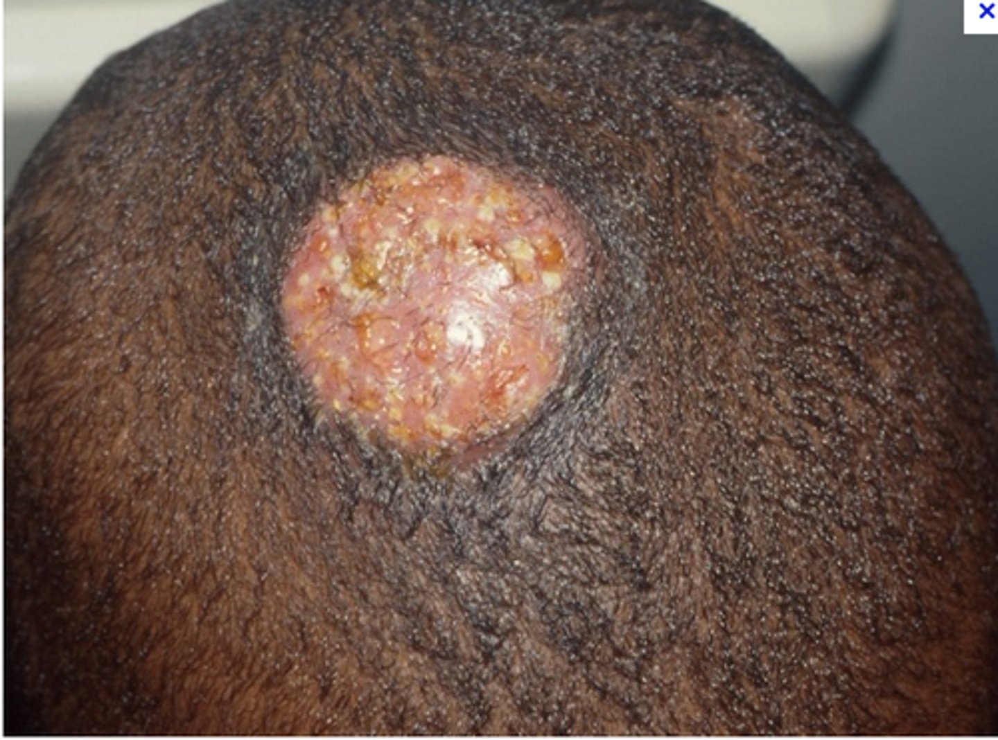 <p>diagnose this image:</p><p>Indurated, boggy, nodule with pustules on scalp</p>