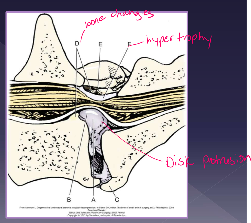 <ul><li><p>degenerative</p><ul><li><p><strong>disc protrusion* most cases</strong></p></li><li><p>ligamentum flavum degeneration</p></li><li><p>dorsal longitudinal ligament hypertrophy</p></li><li><p>articular facet hypertrophy</p></li><li><p>spondylosis</p></li><li><p>instability*</p></li></ul></li><li><p>congenital - very rare</p><ul><li><p>stenosis of canal</p></li><li><p>malarticulation / malformation</p></li><li><p>transitional vertebrae</p></li><li><p>osteochondrosis of vertebral end plate</p></li></ul></li></ul><p></p>