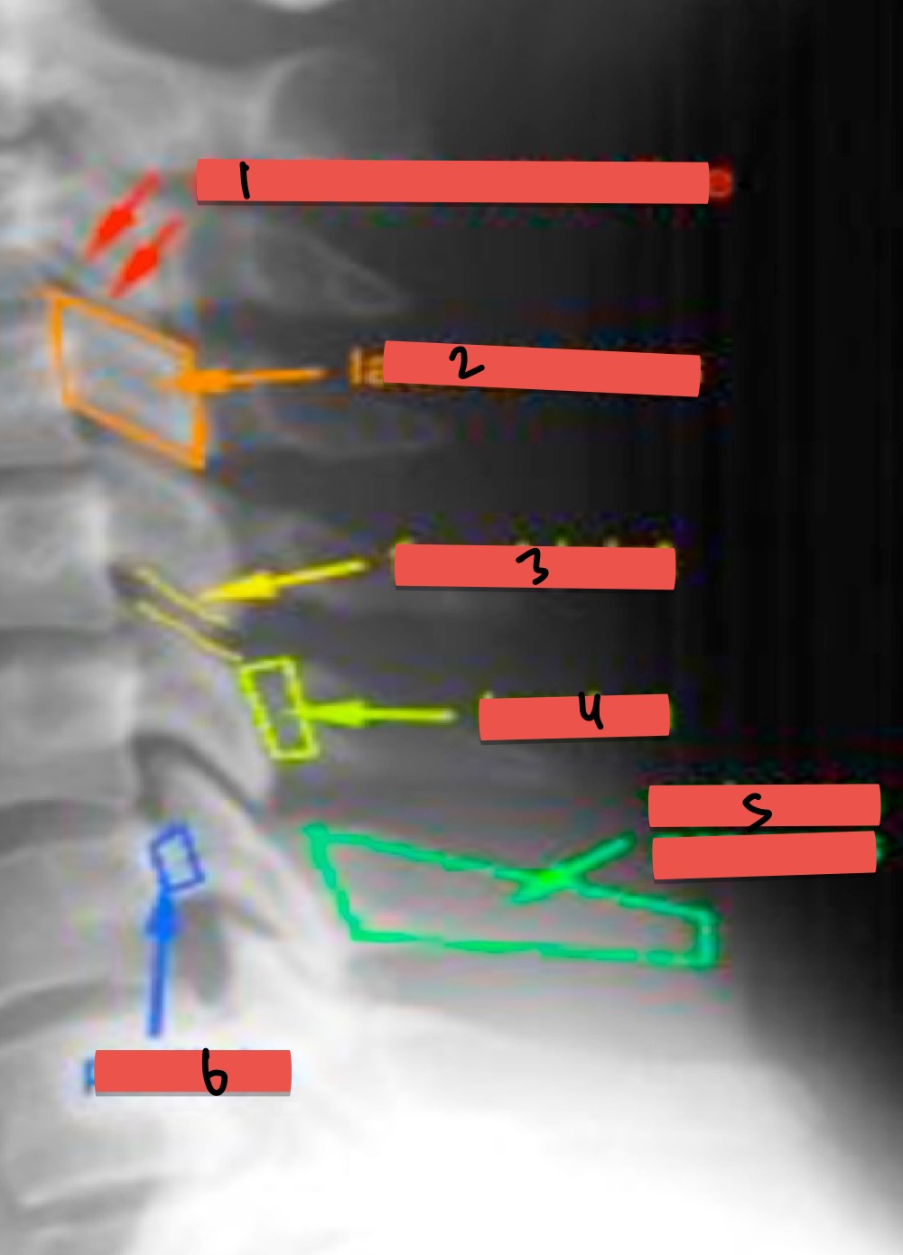 <ol><li><p>double corticle line</p></li><li><p>lageral mass</p></li><li><p>facet joint</p></li><li><p>lamina</p></li><li><p>spinous process</p></li><li><p>pedicle</p></li></ol><p></p>