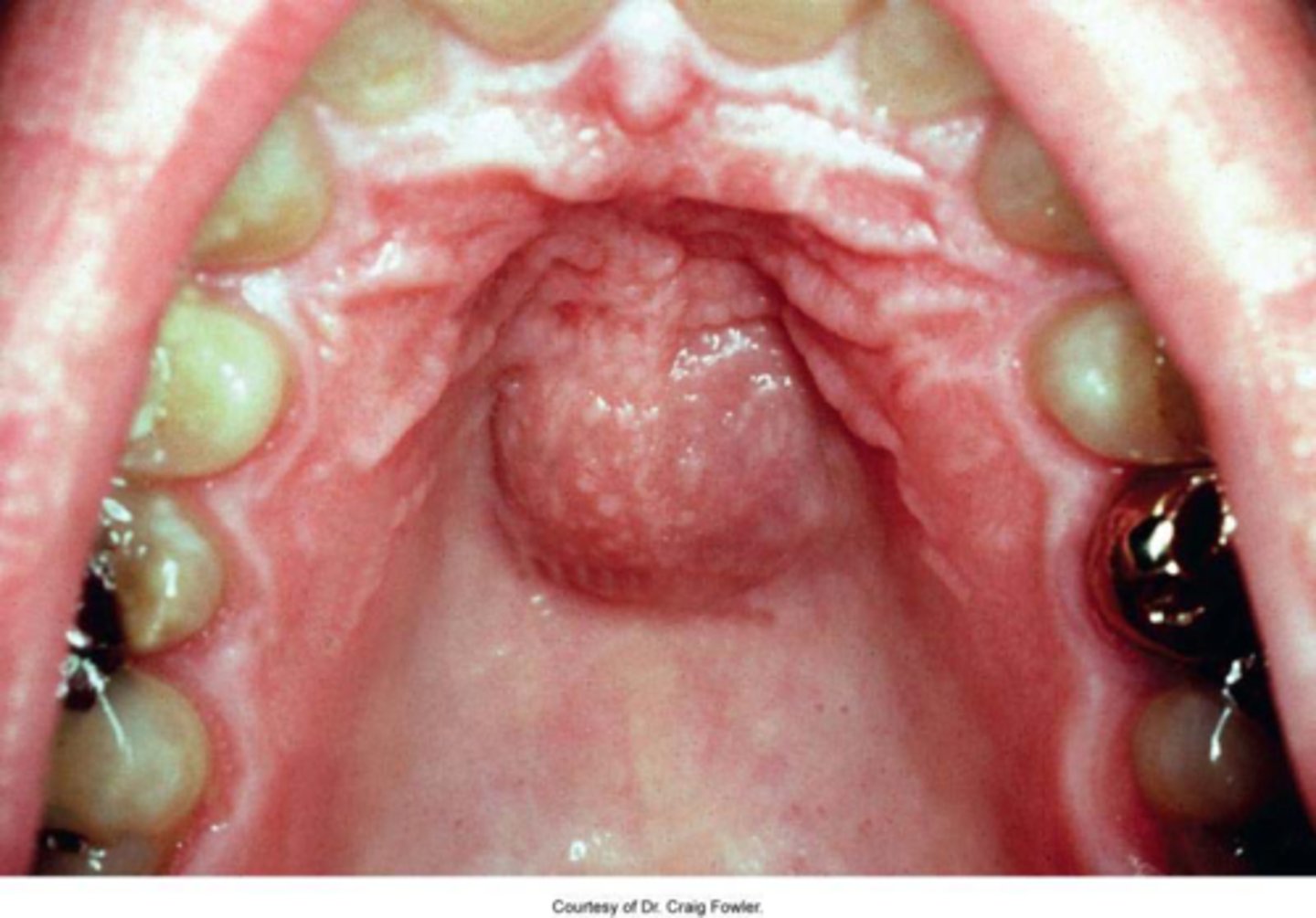 <p>swelling at midline of hard palate (if large)</p>
