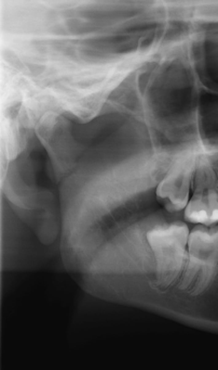 <p>PANOREX showing this fracture pattern. Where is this fracture located?</p><p>- Angle</p><p>- Subcondylar</p><p>- Body</p><p>- Coronoid</p><p>- Ramus</p>