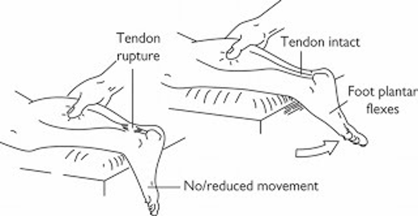 <p>thompson's test → positive = absence of plantar flexion of foot</p>