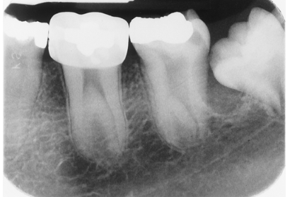 <p>What dental anomaly is seen in this image?</p><p> </p><p>dilaceration</p><p> </p><p>taurodontism</p><p> </p><p>supernumerary tooth</p><p> </p><p>congenitally missing tooth</p>