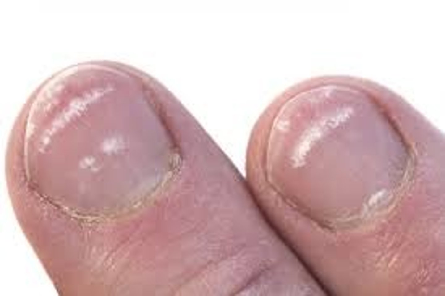 <p>White spots on the nail plate</p><p>Causes:</p><p>-Trauma (construction workers)</p><p>-Manipulation of the cuticle</p>