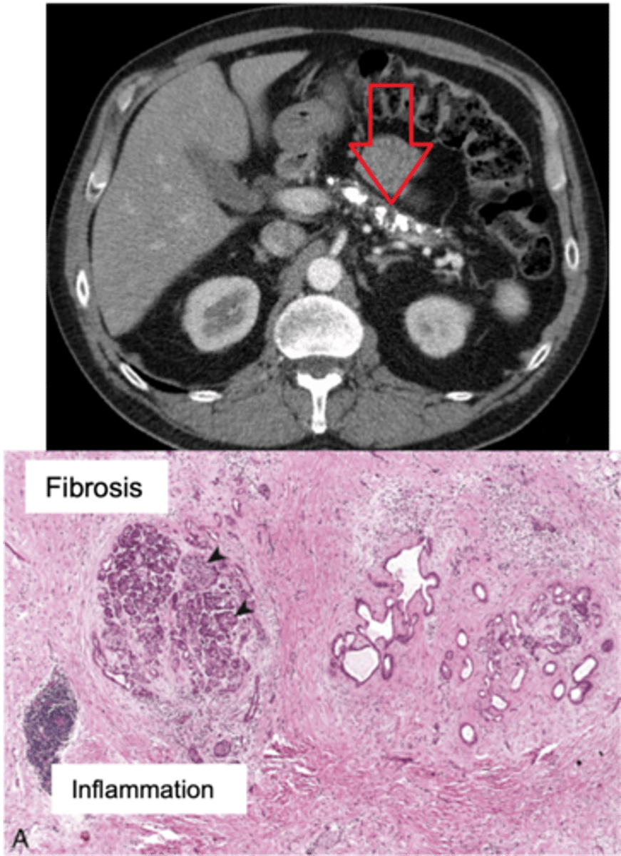 <p>Define Condition:</p><p>Prolonged pancreatic inflammation --&gt; Irreversible destruction of exocrine pancreas + Fibrosis</p><p>-Hx:</p><p>&gt; MCC = Chronic Excess EtOH use</p><p>&gt; May be Idiopathic</p><p>&gt; 25% have GENETIC PREDISPOSITION = Cystic Fibrosis, SPINK1 (encodes trypsin inhibitor) mutation</p><p>&gt; Repeated episodes of Acute Pancreatitis</p><p>&gt; More in MALES</p><p>-Path: Chronic Pancreatic Injury --&gt; Inflammatory Mediators (TGF-Beta &amp; PDGF) ==&gt; Activation/Proliferation of Pancreatic Stellate Cells --&gt; More Periacinar Myofibroblasts ==&gt; Collagen Deposition &amp; Fibrosis</p><p>-Sx/PE:</p><p>&gt; Chronic/recurrent Abd Pain</p><p>&gt; Steatorrhea &amp; Malabsorption</p><p>&gt;&gt; Pancreatic Burnout of enzymes (Pancreatic Insufficiency) --&gt; Less Proteases/Lipases --&gt; Can't Absorb Fat ==&gt; Fat Soluble Vitamin Deficiencies</p><p>-Dx:</p><p>&gt; Imaging (CT): Multiple pancreatic calcifications </p><p>&gt; Gross:</p><p>&gt;&gt; FIRM w/ dilated ducts</p><p>&gt;&gt; Calcified concretions</p><p>&gt; Biopsy:</p><p>&gt;&gt; Parenchymal fibrosis</p><p>&gt;&gt; Smaller size/number of acini --&gt; Acinar Loss</p><p>&gt;&gt; Variable dilation of ducts +/- Inspissated concretions</p><p>&gt;&gt; Chronic Inflammation</p><p>&gt;&gt; Eventual loss of islet of langerhans</p><p>-Tx:</p><p>-Prog:</p><p>&gt; Secondary D2M (loss of Islet of Langerhans)</p><p>&gt; Pancreatic Insuffiency</p><p>&gt; Pancreatic Pseudocysts</p><p>&gt; Increased risk of Pancreatic Carcinoma</p>