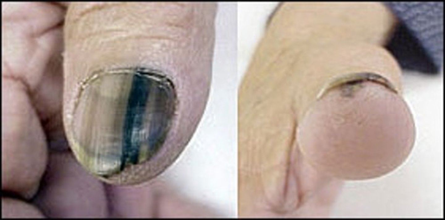 <p>-Longitudinal black bands of nails caused by pigmentation under the nails</p><p>-Disrupts nail growth</p><p>-Biopsy is needed to rule out melanoma (cancer)</p>
