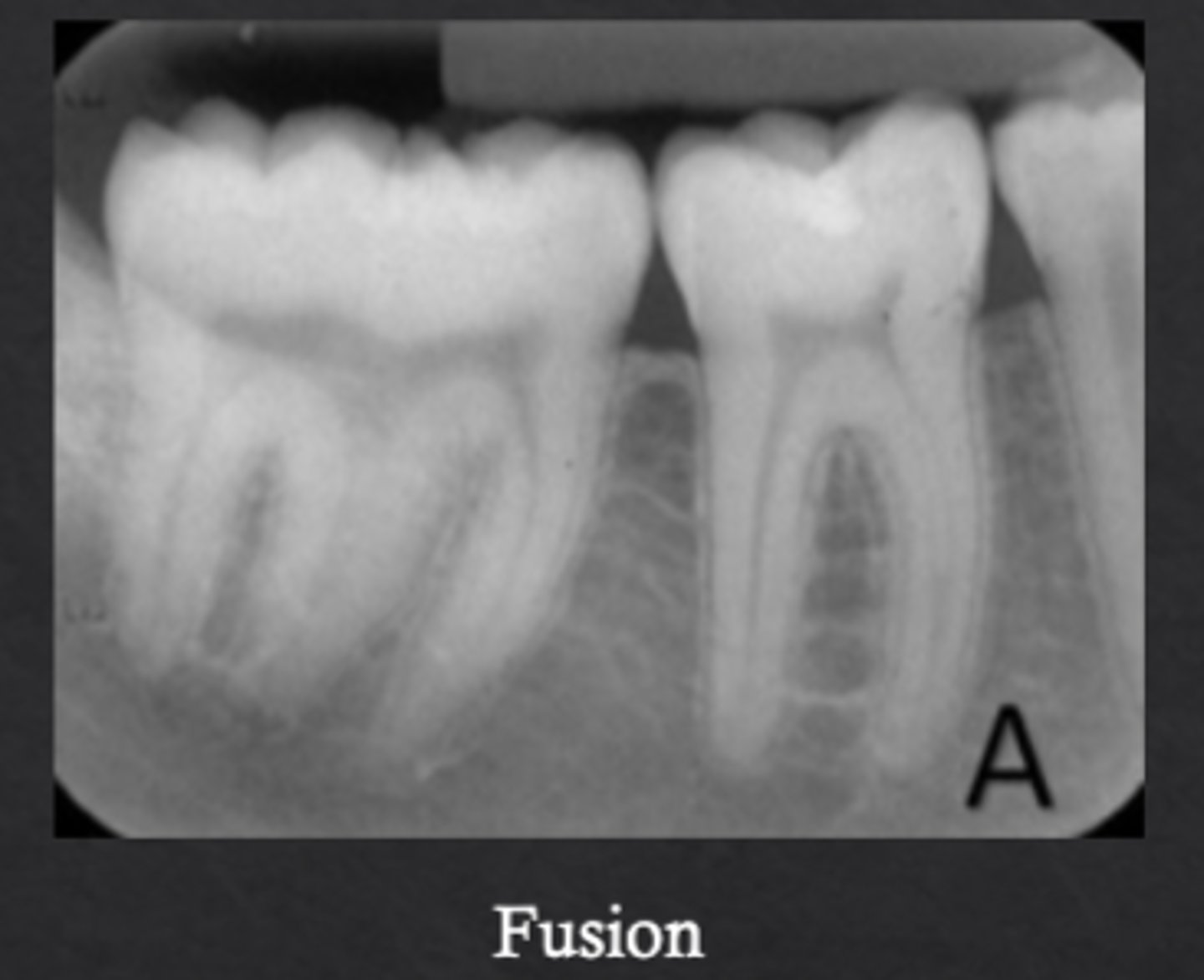 <p>Two tooth buds fuse to form one tooth</p>