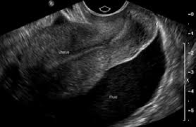 <p><strong><mark data-color="yellow" style="background-color: yellow; color: inherit;"><u>MC area of intraperitoneal fluid collection</u></mark></strong></p><p>can happen in anterior cul-de-sac</p>