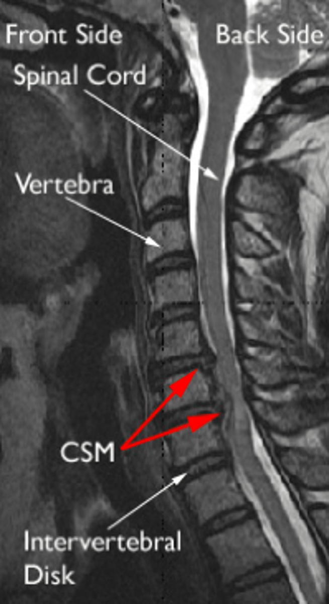 <p>compression of the spinal cord</p><p>- mainly caused by disc protrusion</p>