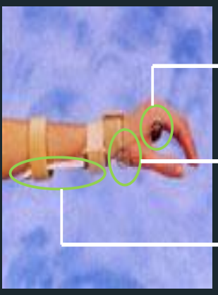 <p>Dynamic Wrist Extension Splint -  Parts</p>