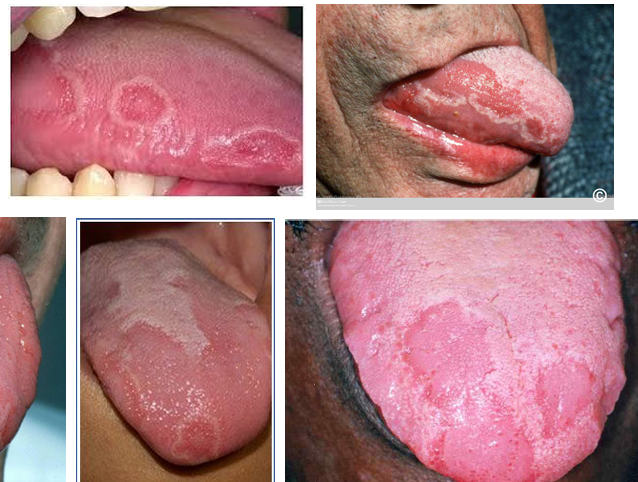 <p>-well demarcated red areas surrounded by a slightly elevated yellow-white serpentine/scalloped border</p><p>-red zone = atrophic filiform papillae</p><p>-anterior 2/3 of tongue, tip and lateral borders, can happen ectopically too (buccal/labial mucosa, soft palate)</p><p>-multiple or solitary lesion(s)</p><p>-usually asymptomatic, but some patients experience burning sensation</p><p>-biopsy not indicated</p><p>-begins as small white patch, develops central erythematous atrophic zone, enlarges centrifugally</p>