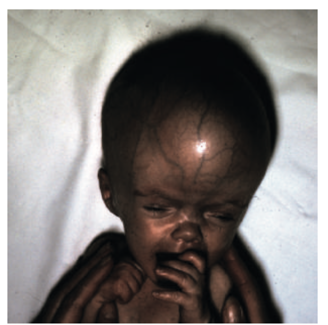 <ul><li><p>bulging AF</p></li><li><p>enlarged head circumference </p></li><li><p>sun-setting eyes </p></li><li><p>dilated scalp veins </p></li></ul>