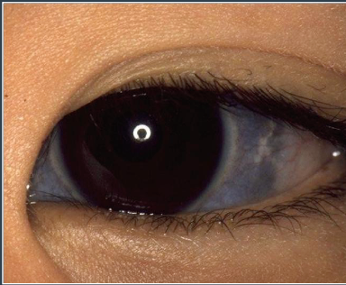 <p>What condition is a blue sclera associated with?</p>