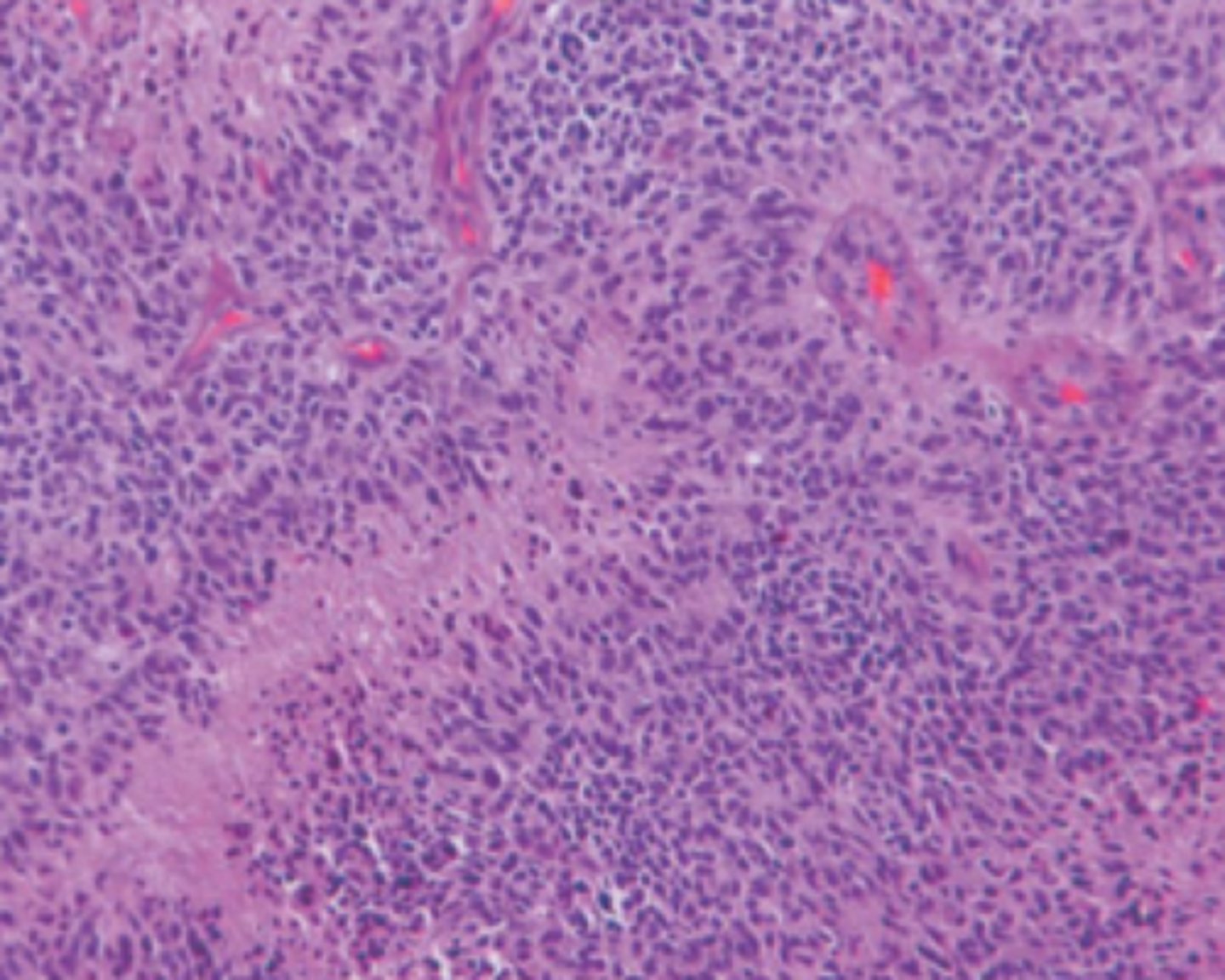 <p>high grade astrocytoma present with necrosis and microvascular proliferation</p>