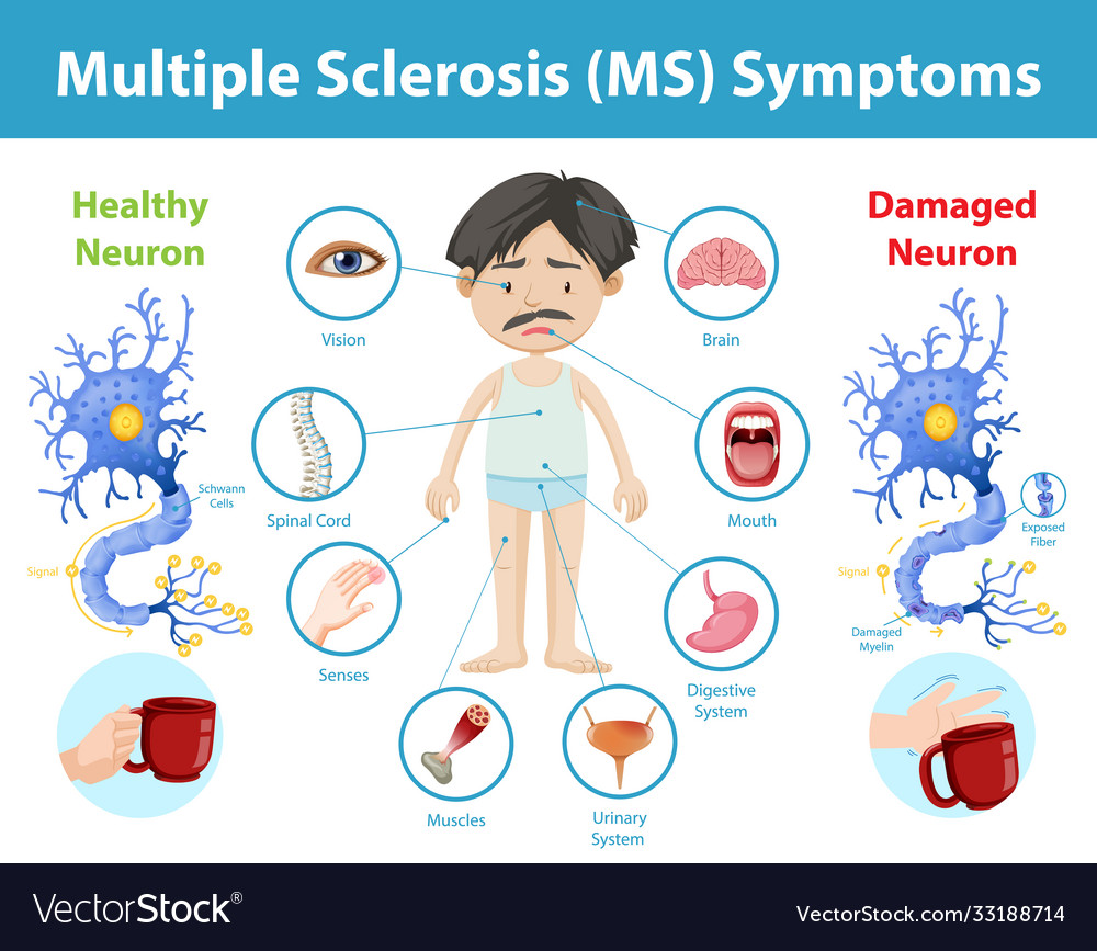 <ul><li><p>dysarthria (speech problems)</p></li><li><p>optic neuritis</p></li><li><p>fatigue</p></li><li><p>spasms</p></li><li><p>incontinence</p></li><li><p>depression</p></li></ul><p></p>