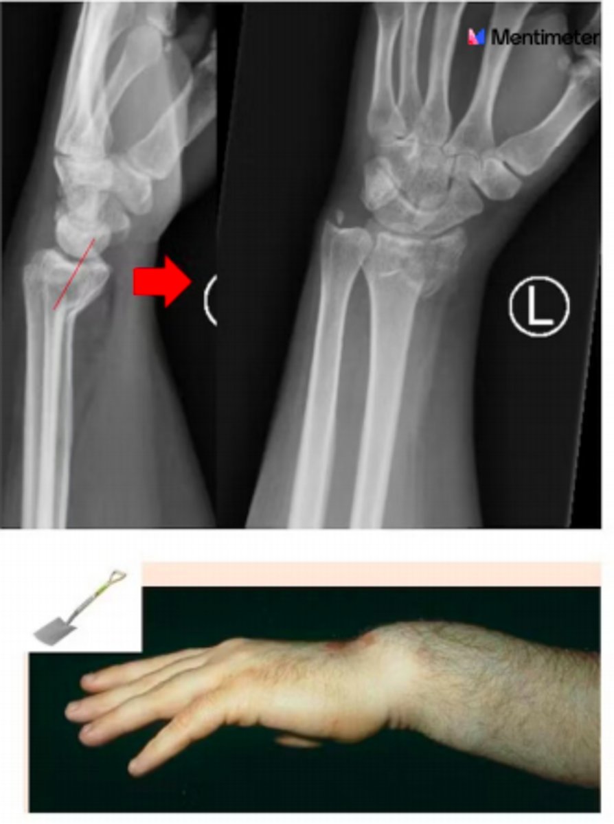 <p>Extra-articular fracture of the distal radius</p><p>Volar angulation +/- volar displacement - garden spade deformity </p><p>Caused by FOOSH to the BACK of the hand </p>