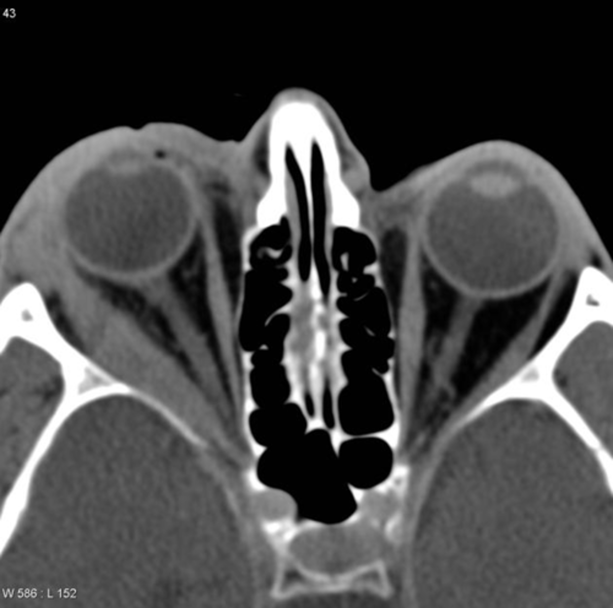 <p>the tendons &amp; extraocular muscles are enlarged</p>