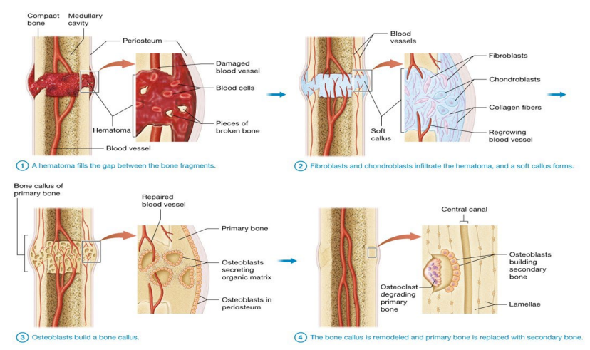 <ul><li><p>Hematoma (blood clot) fills in gap between bone fragments</p><ul><li><p>Mass of blood cells and proteins form due to ruptured blood vessels</p></li><li><p> Bone cells in surrounding area die</p></li></ul></li><li><p>Fibroblasts and chondroblasts (from periosteum) infiltrate hematoma and form soft callus (mixture of hyaline cartilage and collagenous connective tissue); bridges gap between fragments </p><ul><li><p>Fibroblasts form dense irregular collagenous connective tissue </p></li><li><p>Osteogenic cells become chondroblasts; secrete hyaline cartilage</p></li></ul></li><li><p>Osteoblasts build bone callus (hard callus); collar of primary bone made by osteoblasts in periosteum; forms bridge between fragments </p></li><li><p>Bone callus is remodeled and primary bone is replaced with secondary bone; bone regains previous structure and strength after several months</p></li></ul><p></p>