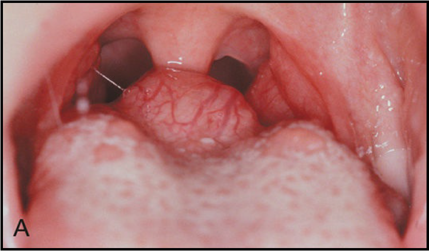 <p>give an example of ectopia elsewhere in the body </p>