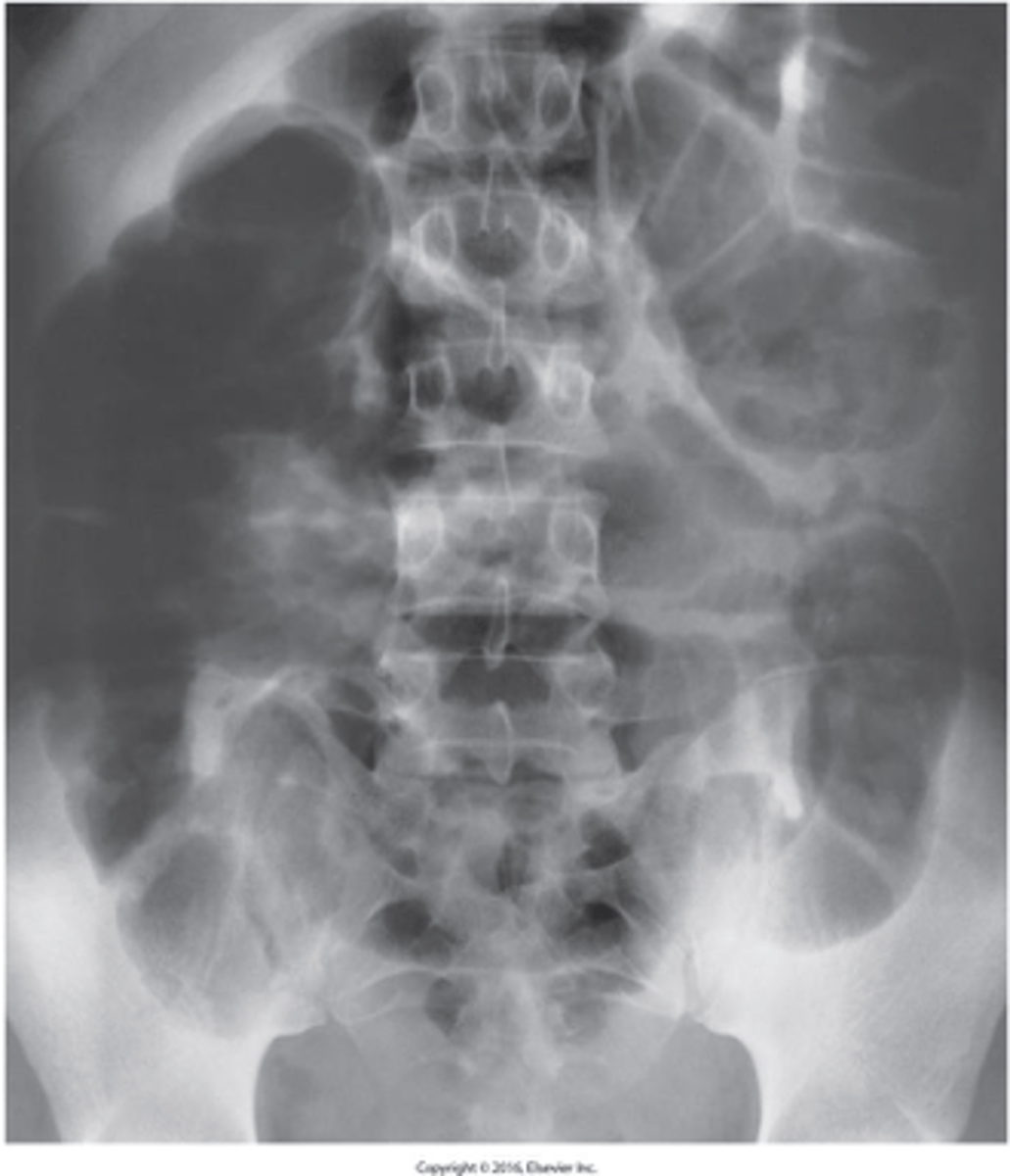 <p>What is adynamic ileus ?</p>