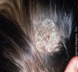 <p><strong>Tinea Capitis</strong></p><p>-Fungal infection of the _____ most common in prepubertal children </p><ul><li><p>Most commonly with trichophyton or microsporum species </p></li><li><p>Contracted from infected person, animal, or contaminated object </p></li></ul><p>-_______, scaly patches with ________</p><ul><li><p>May also be associated with visible _____ dots (broken hair) in areas of alopecia </p></li></ul><p>-KOH prep may show fungal spores and/or _______. Could also do a fungal culture if diagnosis is uncertain</p><p>-Treatment</p><ul><li><p>Systemic antifungal agents → ____________ (DOC) x 6-12 weeks. Check LFTs and ___ if therapy > 8 weeks </p></li><li><p>Selenium sulfide or __________ shampoo twice daily </p></li></ul><p></p>