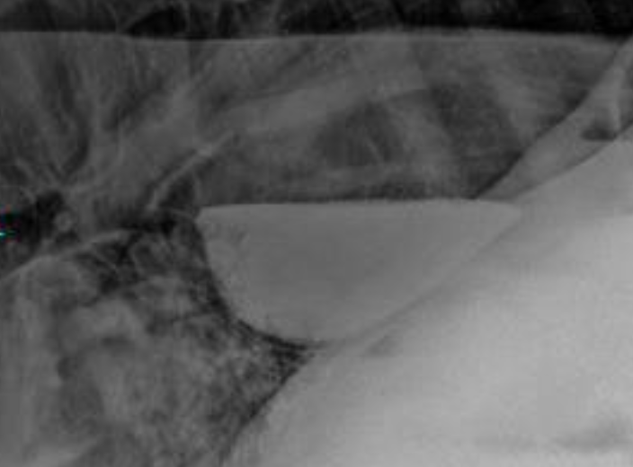 <p>-chronic obstruction (choke, stricture, hiatal hernia, vascular ring anomaly, achalasia)</p><p>-vagal nerve dysfunction</p><p>-myopathy (WMD/botulism)</p>