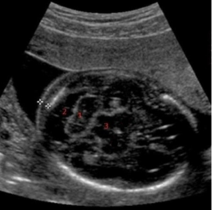 <p>what is #2 </p><p>a) caudate nucleus</p><p>b) cisterna magna</p><p>c) cerebellum</p><p>d) nuchal skin fold</p>