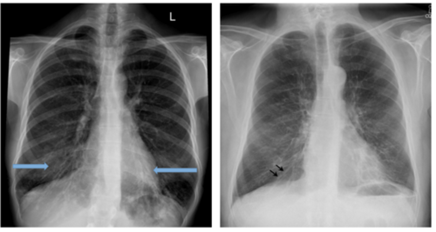 <p>Dx. What is this finding?</p>