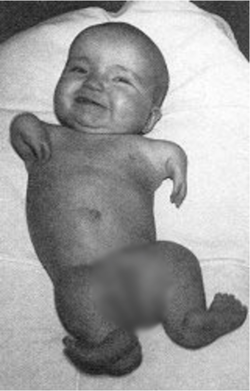 <p>Shortened limbs resembling flippers of a seal due to lack of some or all of the long bones in a fetus</p>