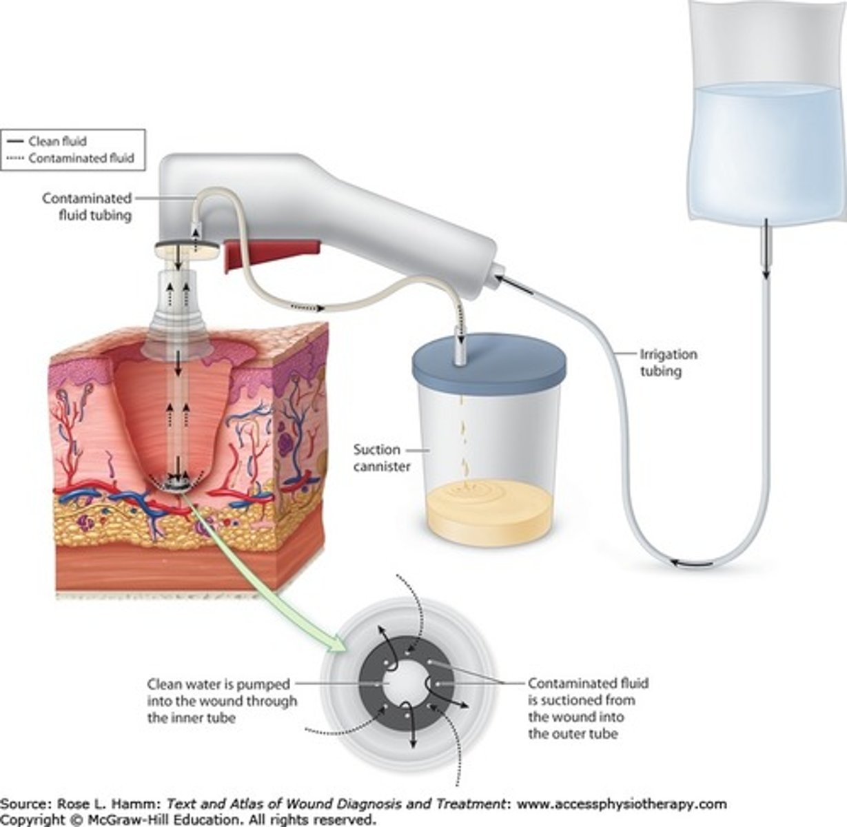 <p>WOUND HEALING MODALITY</p><p>form of mechanical debridement (low pressure)</p><p>- direct, localized hydrotherapy to wound via a pulsed stream of sterile saline</p><p>- average rx time: 5-20 mins</p><p>- work non-necrotic areas first</p><p>sterile technique is essential!!</p><p>(PPE and face mask needed to not inhale bacteria)</p>