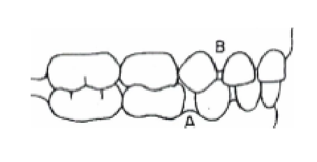 <p>maxillary → mesial to canine<br>mand → distal to canine</p>