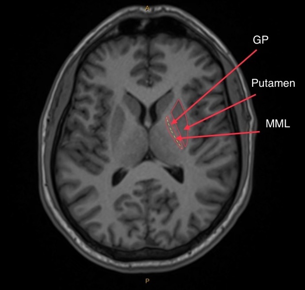 <p>Globus pallidus.</p>