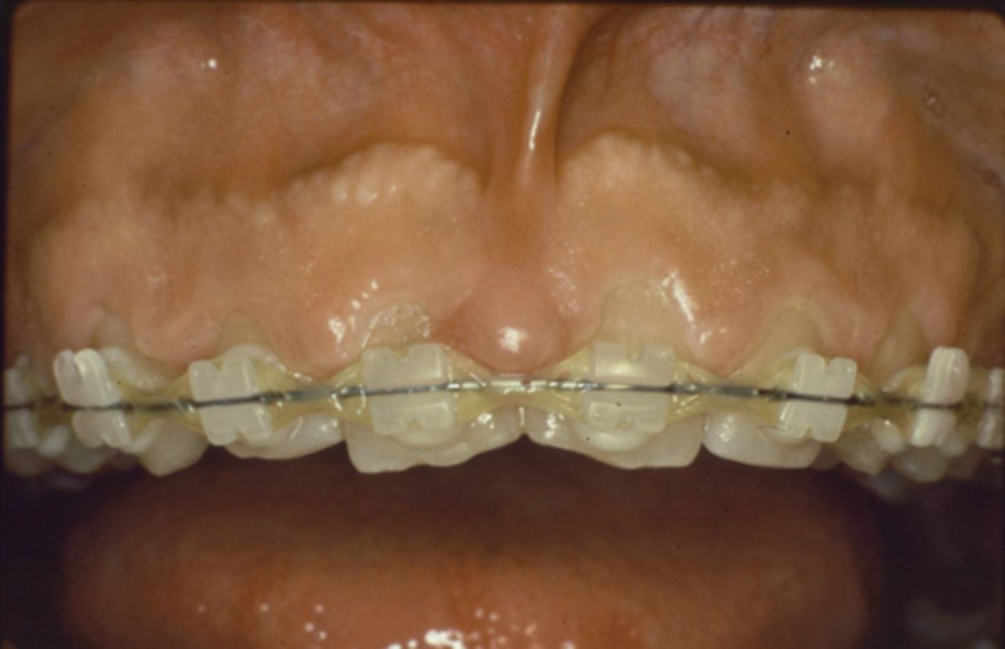 <p>You patient present like this clinically, but radiographically the crowns look much longer. What is the diagnosis?</p>