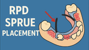 <p>the process of attaching wax patterns of sprues to a wax-up of the RPD framework<span><span>. These sprues form channels that will allow molten metal to flow into the mold to cast the final metal framework after the wax is removed. Proper spruing is critical to prevent casting defects and ensure the RPD framework fits correctly</span></span></p>