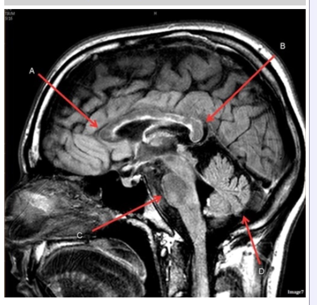 <p><span><strong>&nbsp;Letter C in Image 7 is pointing to:</strong></span></p><p><span>&nbsp;A. Pons</span></p><p><span>&nbsp;B. Cerebellum</span></p><p><span>&nbsp;C. Hypothalamus</span></p><p><span>&nbsp;D. Genu of the corpus callosum</span></p><p><span>&nbsp;E. Splenium of the corpus callosum</span></p>