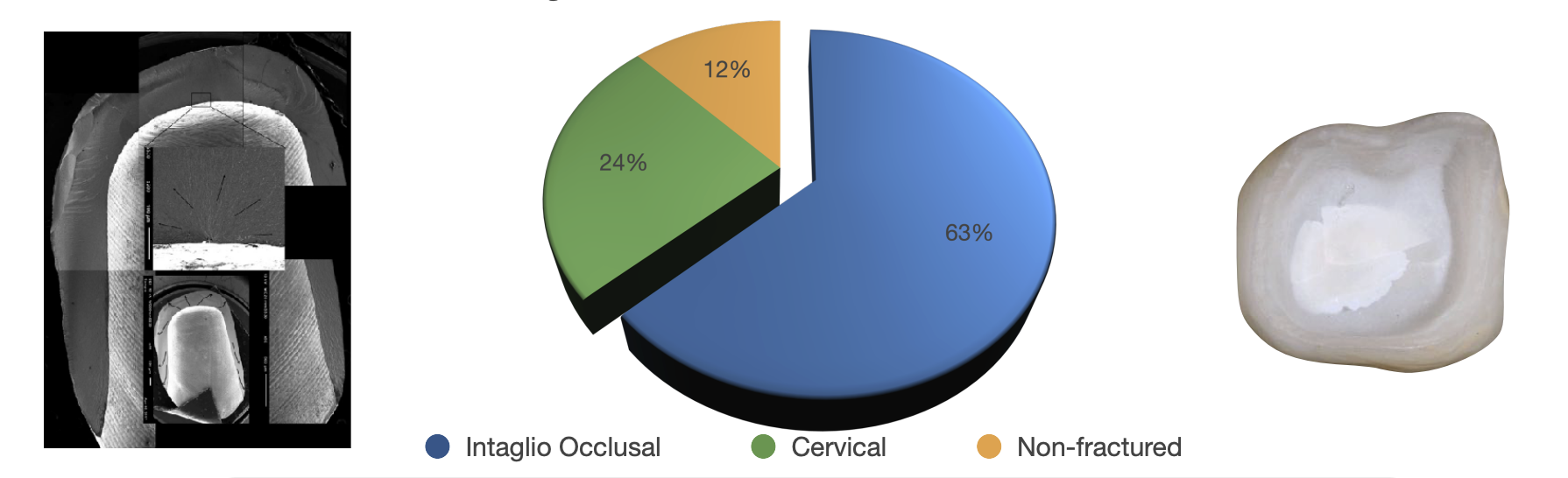 <ol><li><p>intaglio occlusal </p></li><li><p>cervical </p></li><li><p>non-fx </p></li></ol><p></p>
