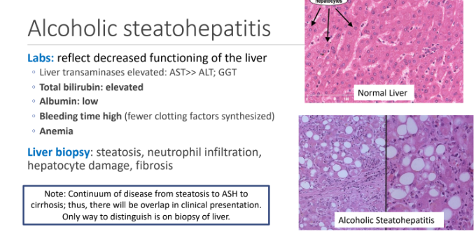 <ol><li><p>steatosis, </p></li><li><p>neutrophil infiltration,</p></li><li><p>hepatocyte damage, </p></li><li><p>fibrosis</p></li></ol><p></p>