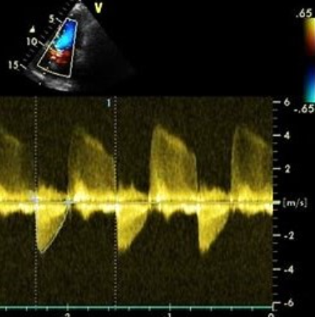 <p>Identify the spectral Doppler waveform:</p>