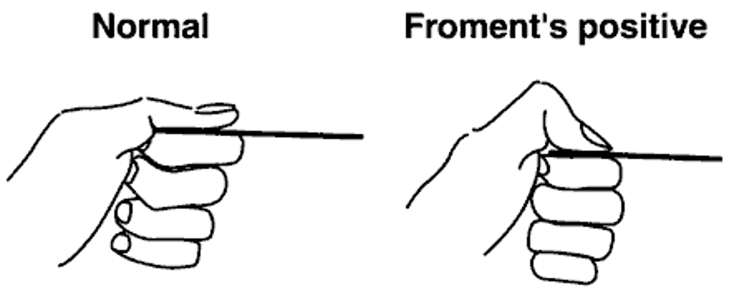 <p>Ulnar nerve dysfunction</p>
