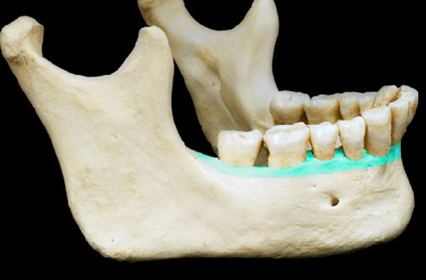 <p>Of the Mandible</p>