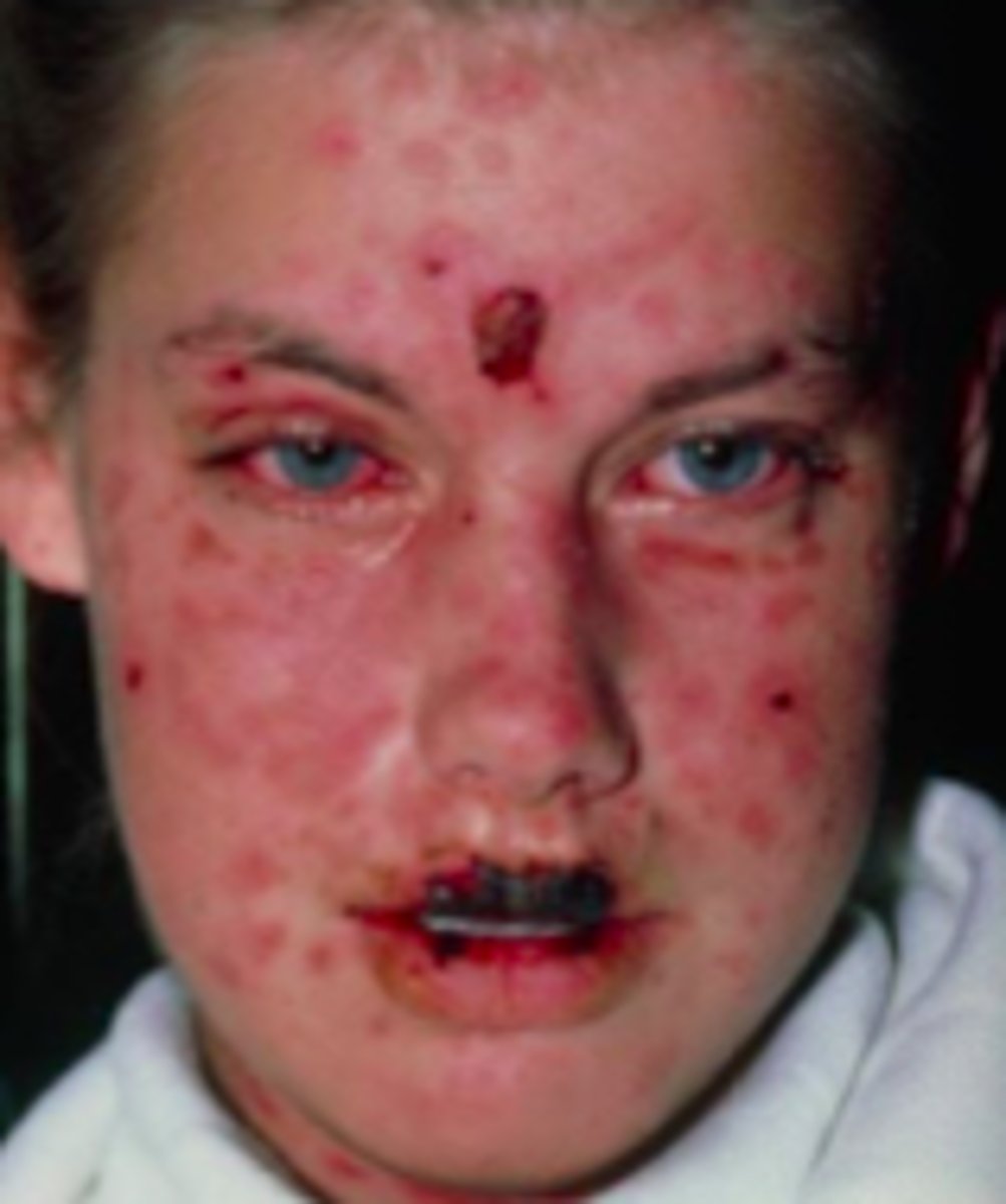 <p>Desquamation Disorders:</p><p>Overview:</p><p>- Severe, mucocutaneous reactions</p><p>- Extensive necrosis and detachment of epidermis</p><p>- Most commonly triggered by medications (usually antibiotics)</p><p>- Mucous membranes affected in over 90% of patients (usually at 2+ distinct sites)</p><p>- Skin detachment is &lt;10% of TBSA (total body surface area)</p><p>- Initially presents with severely chapped lips and sore throat sometimes, as well as signs of conjunctivitis</p>