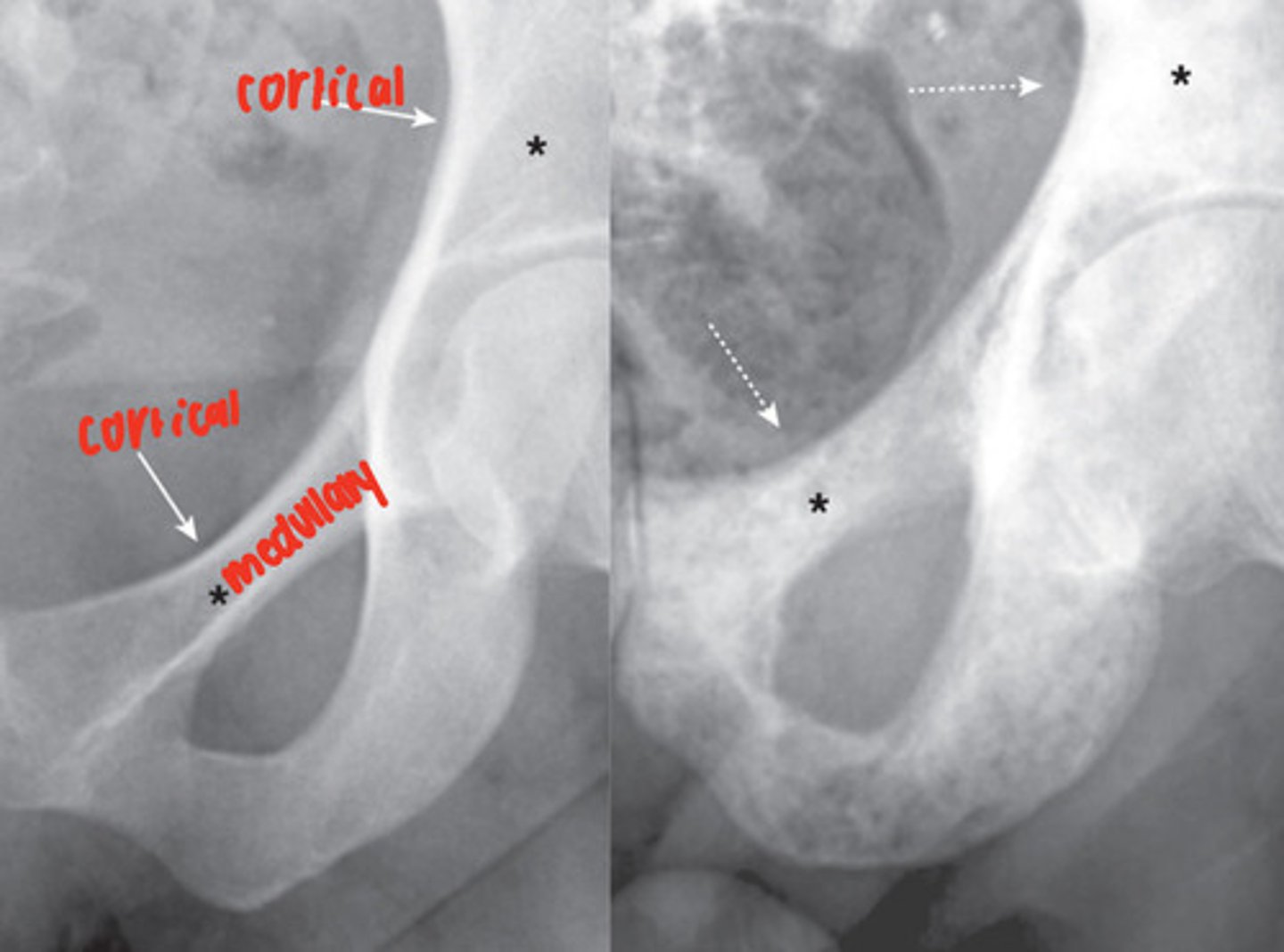 <p>malignancy that has spread into the bone, lesions most often seen in vertebrae, ribs, pelvis, humeri, femora</p>