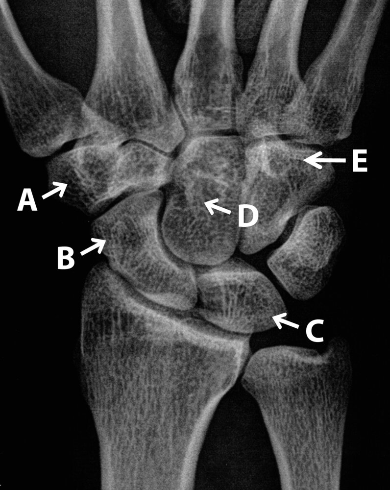 <p>30. Carpal bones serve, among other things, as points of origin for short hand muscles.</p><p>The muscles flexor digiti minimi brevis and opponens digiti minimi originate directly from one of the bones labeled A to E in the X-ray image. (Any indirect origins via the flexor retinaculum from other bones are not considered.)</p><p>This typically refers to the bone labeled:</p>