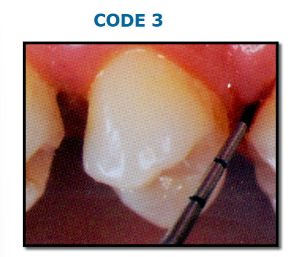 <p>colored area of probe partially visible, pockets depths between 3.5 to 5.5 mm</p>