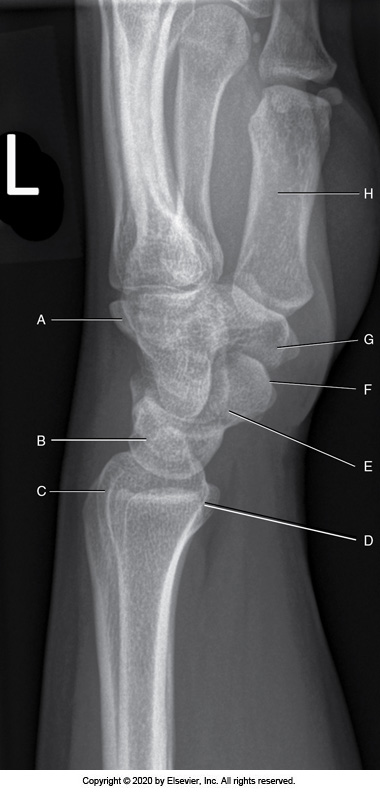 <p>Identify the labeled "G" anatomy in the image below:</p><p>Trapezium</p><p></p><p>Lunate</p><p>&nbsp;</p><p>Pisiform</p><p>&nbsp;</p><p>Capitate</p>