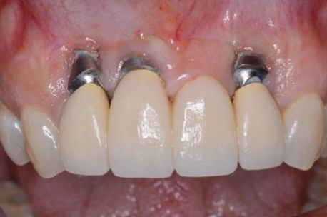 <p>What are the consequences of having an incorrect buccal/lingual implant position?</p>