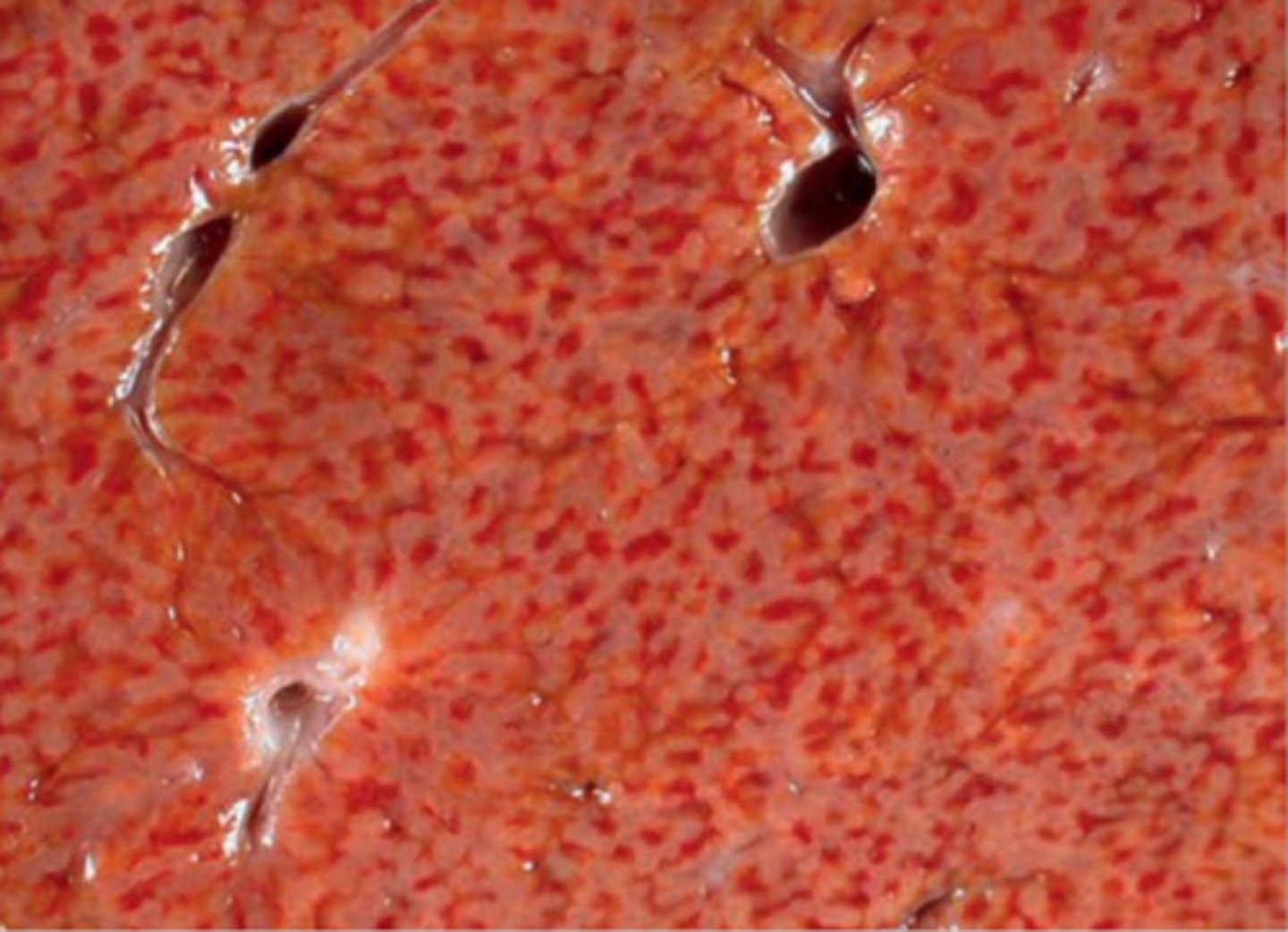 <p>Nutmeg liver (red centrilobular areas with pale surrounding areas), rounded margins of central lobes, capsular fibrosis</p>