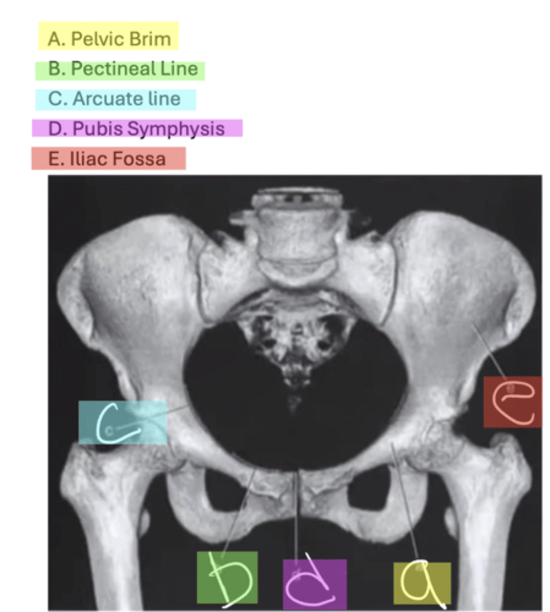 <p>A. Pelvic Brim</p><p>B. Pectineal Line</p><p>C. Arcuate line</p><p>D. Pubis Symphysis</p><p>E. Iliac Fossa</p>