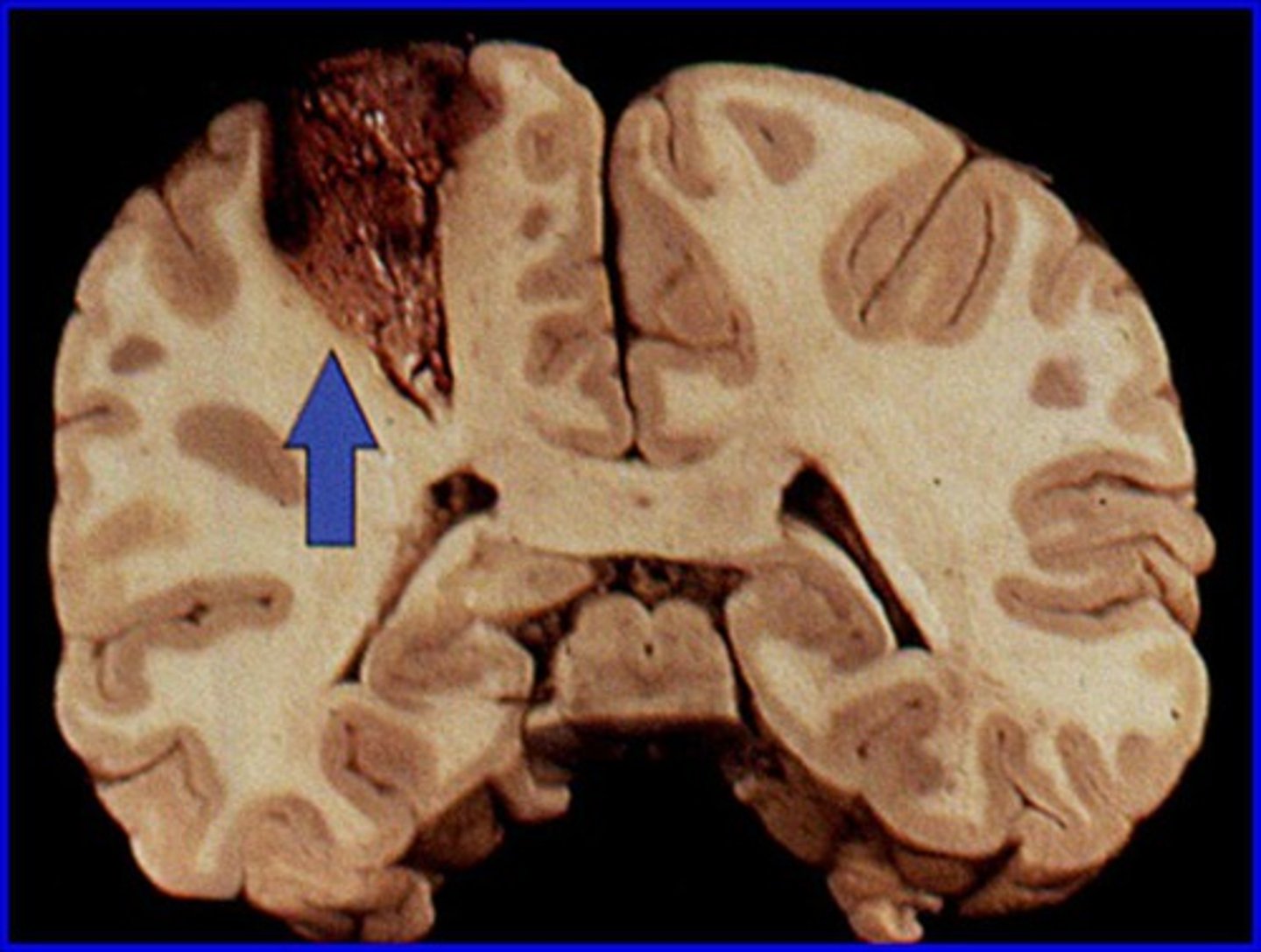 <p>Watershed infarcts in ACA-MCA watershed zone region cause these symptoms:</p>