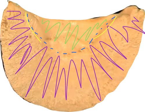 this is the sole of the distal phalanx. the lines in yellow are called